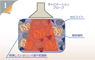 お腹にキャビテーションを当てているっ断面図