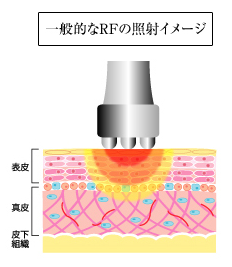 一般的なRFの照射イメージ