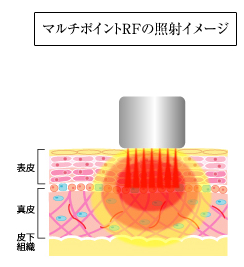 サーマルフラクショナル(RF)の照射イメージ