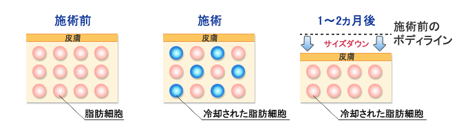 施術前、脂肪細胞は通常で施術を冷却し、サイズダウンをはかります