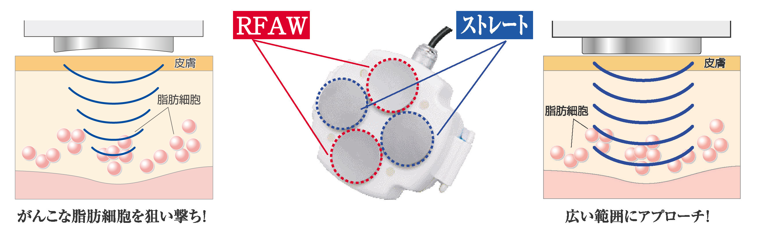 HIFUは頑固な脂肪細胞を狙い撃ちし、ストレートは広い範囲にアプローチします。