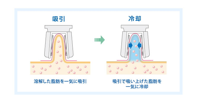 吸引により、溶解した脂肪を一気に吸引し、冷却により吸引で吸い上げた脂肪を一気に冷却します